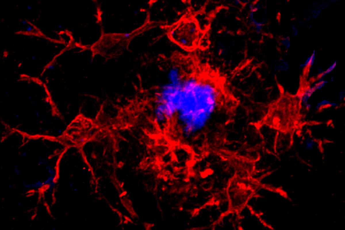 Photo of microglia in red surrounding an amyloid plaque in blue from "CD33 isoforms in microglia and Alzheimer's disease: Friend and foe" by Ghazaleh Eskandari-Sedighi, Jaesoo Jung and Matthew S. Macauley.