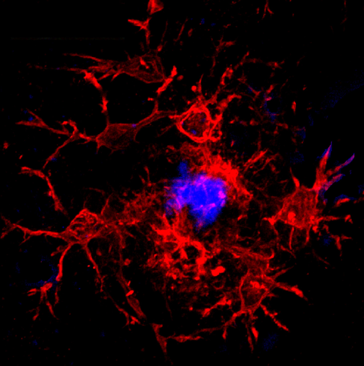  Photo of microglia in red surrounding an amyloid plaque in blue from "CD33 isoforms in microglia and Alzheimer's disease: Friend and foe" by Ghazaleh Eskandari-Sedighi, Jaesoo Jung and Matthew S. Macauley.